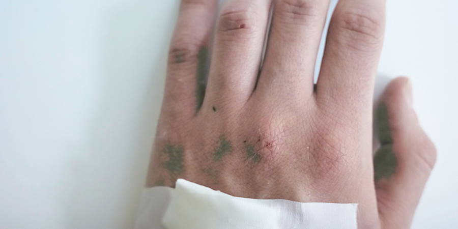 Monkeypox rash in a white male